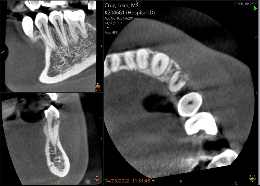 External cervical resorption - Pre-op X-ray case 2